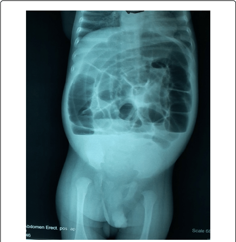 Abdominal Xray Erect Position PNG