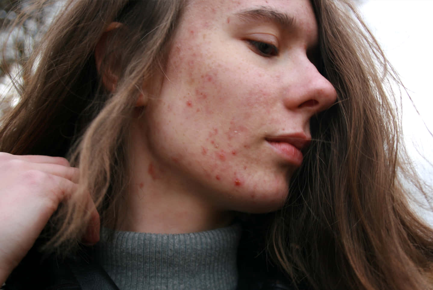 Acne Affected Skin Portrait Wallpaper