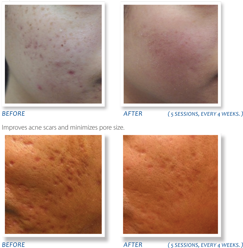 Acne Scar Treatment Before After Comparison PNG
