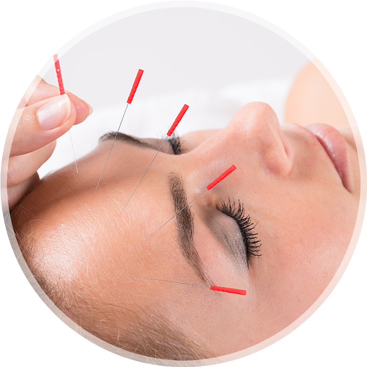 Acupuncture_ Therapy_for_ Headache PNG