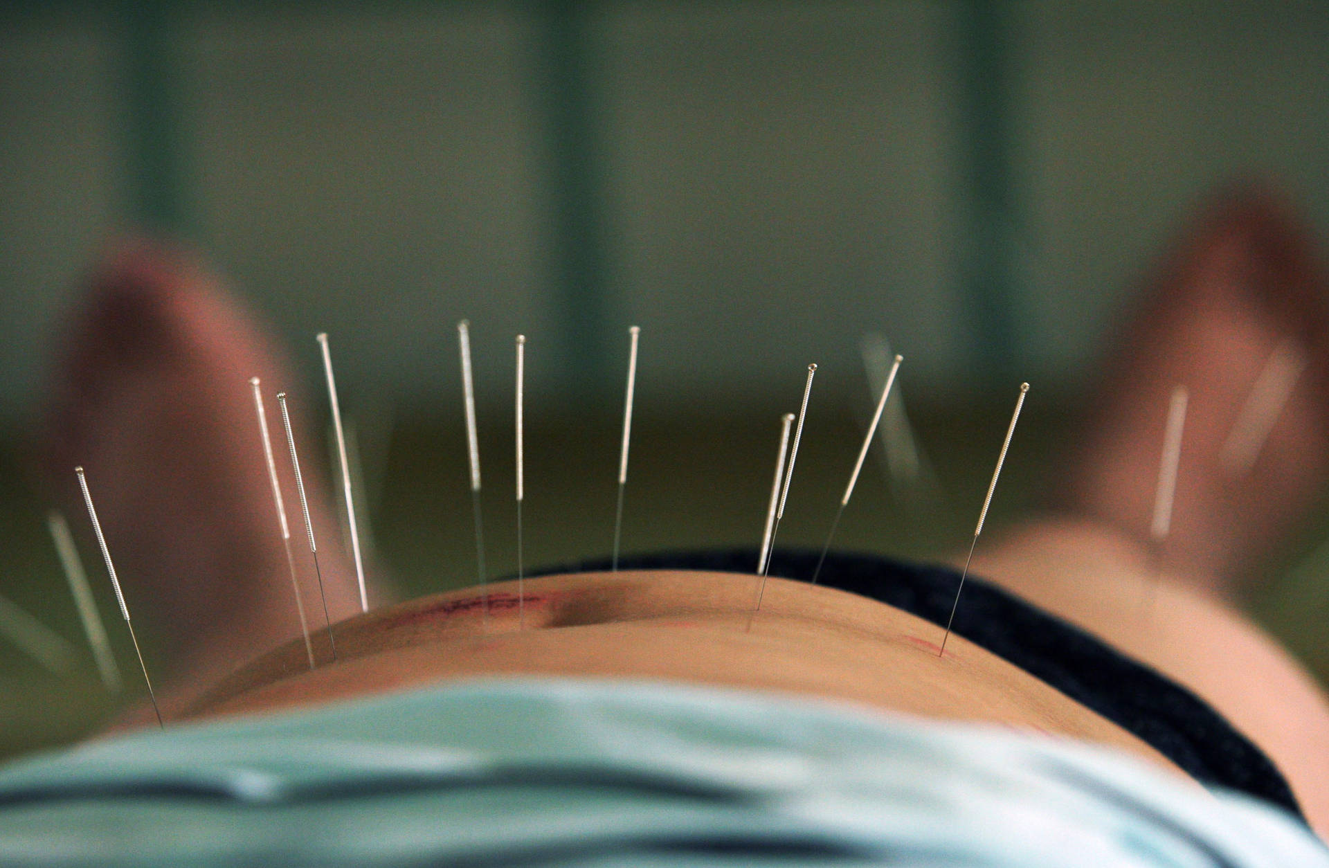 A Professional Acupuncturist Practicing Alternative Medicine, Using Needles on Patient's Abdomen. Wallpaper
