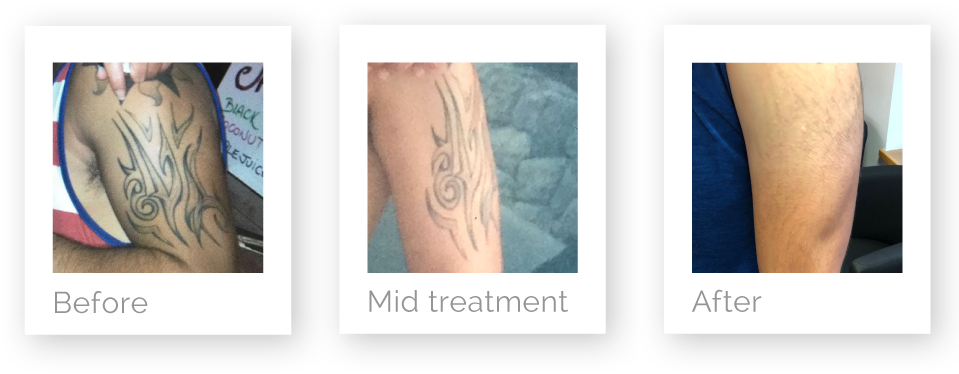 Arm Tattoo Removal Progression PNG