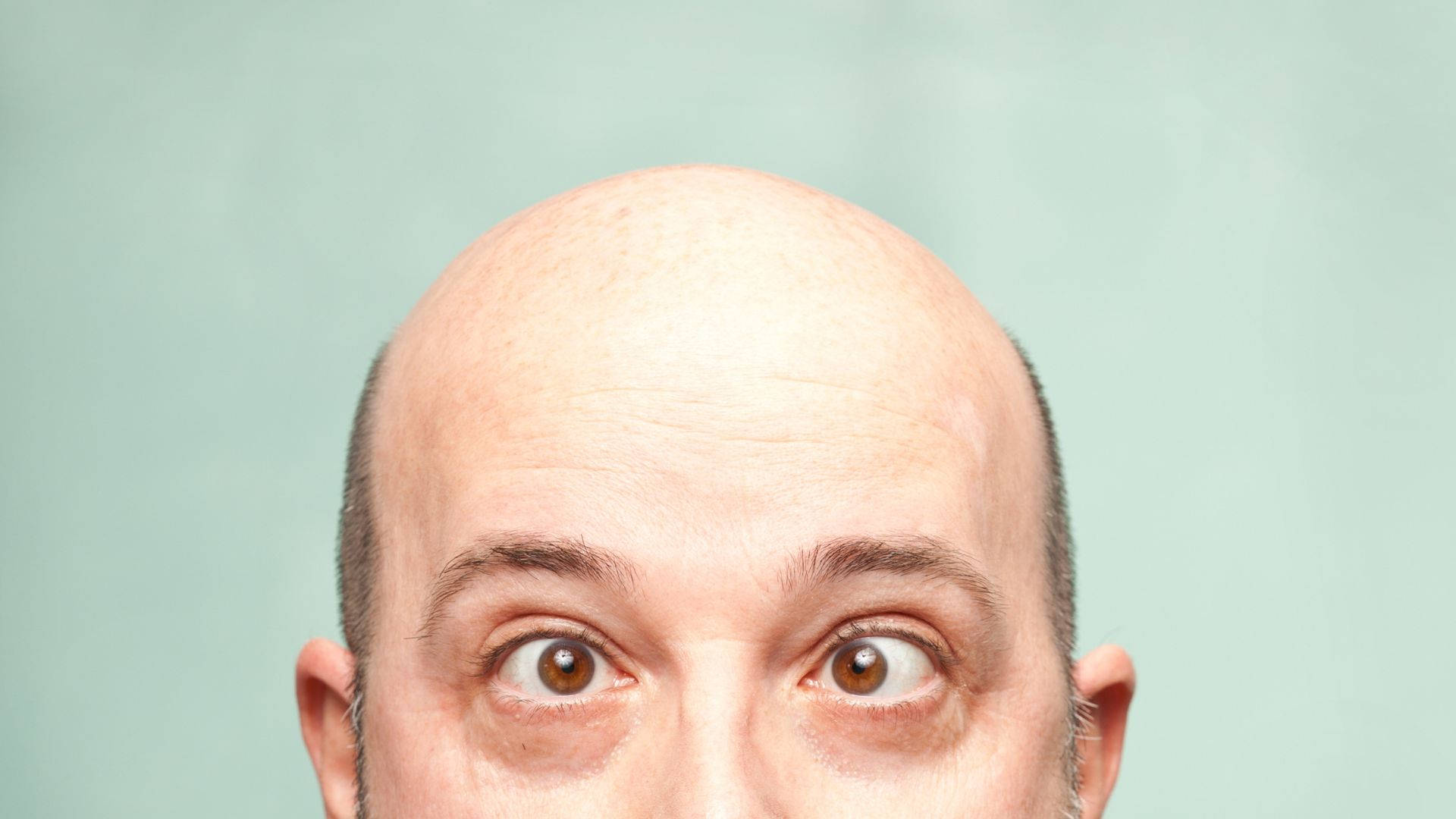 Bald Man With Crossed Eyes Picture
