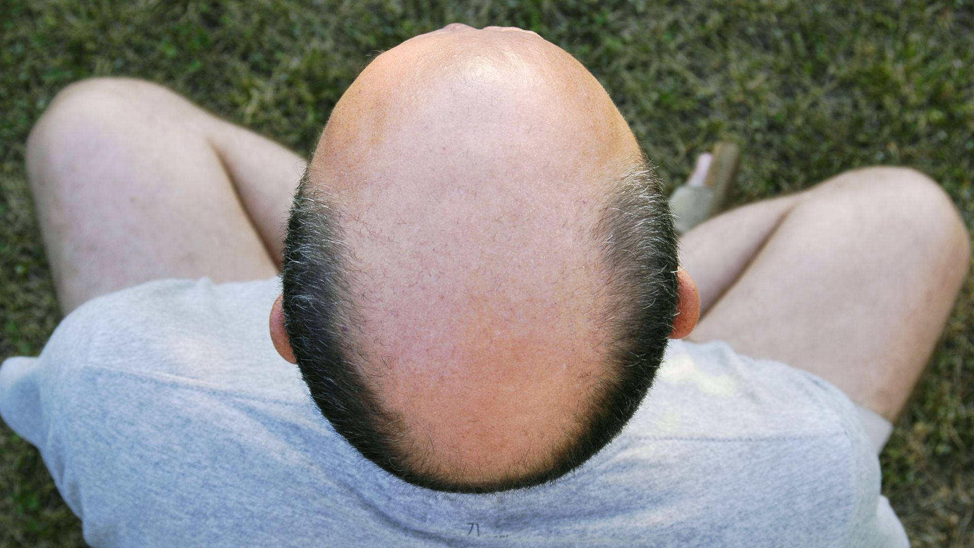 Bald Man With Side Hair Picture