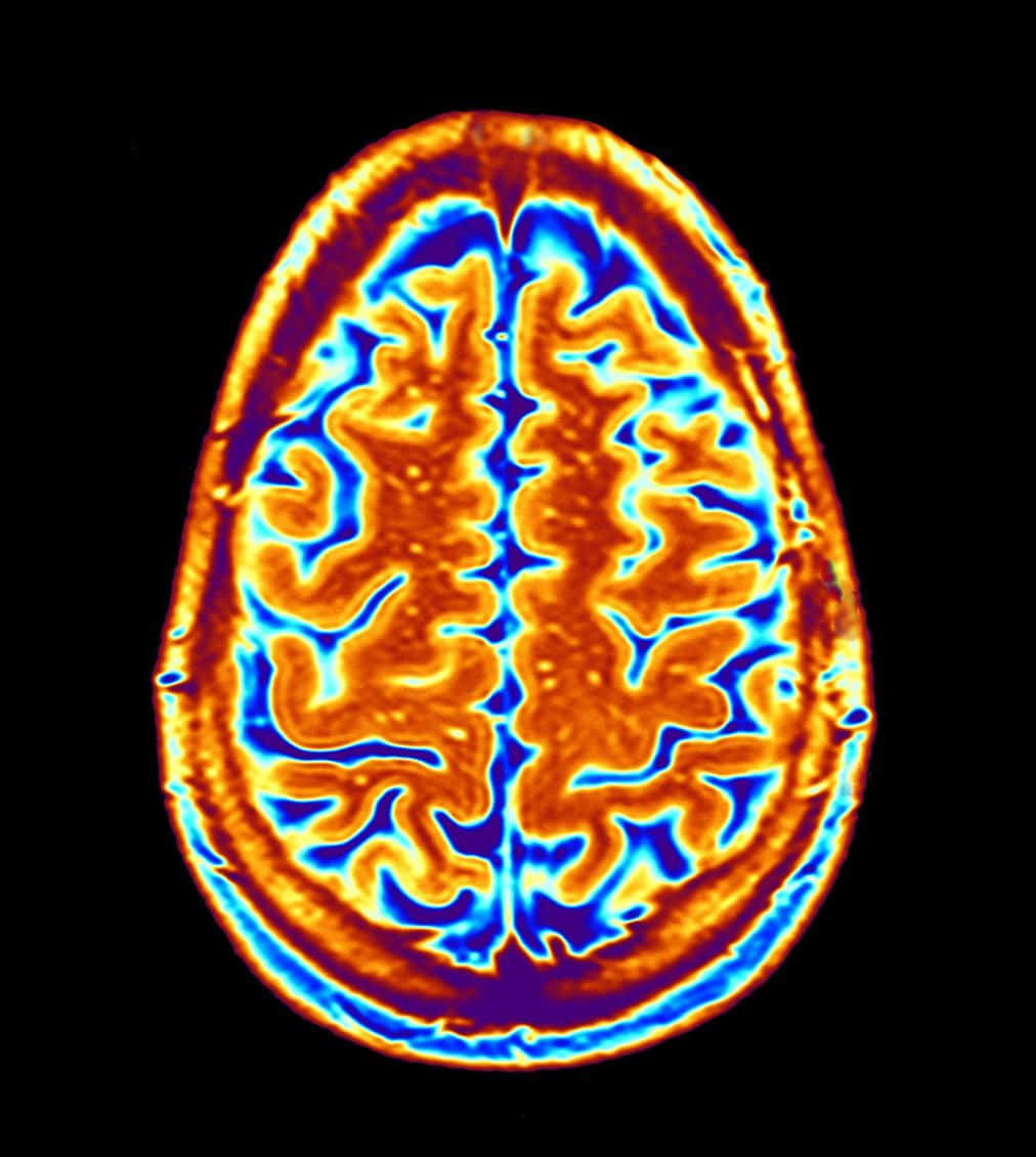 En MRI-billede af et hjerne.
