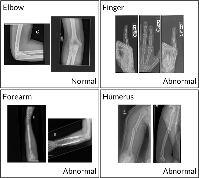 Comparative Xray Images Upper Limb PNG