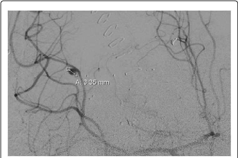 Coronary_ Angiogram_with_ Stent_ Placement PNG