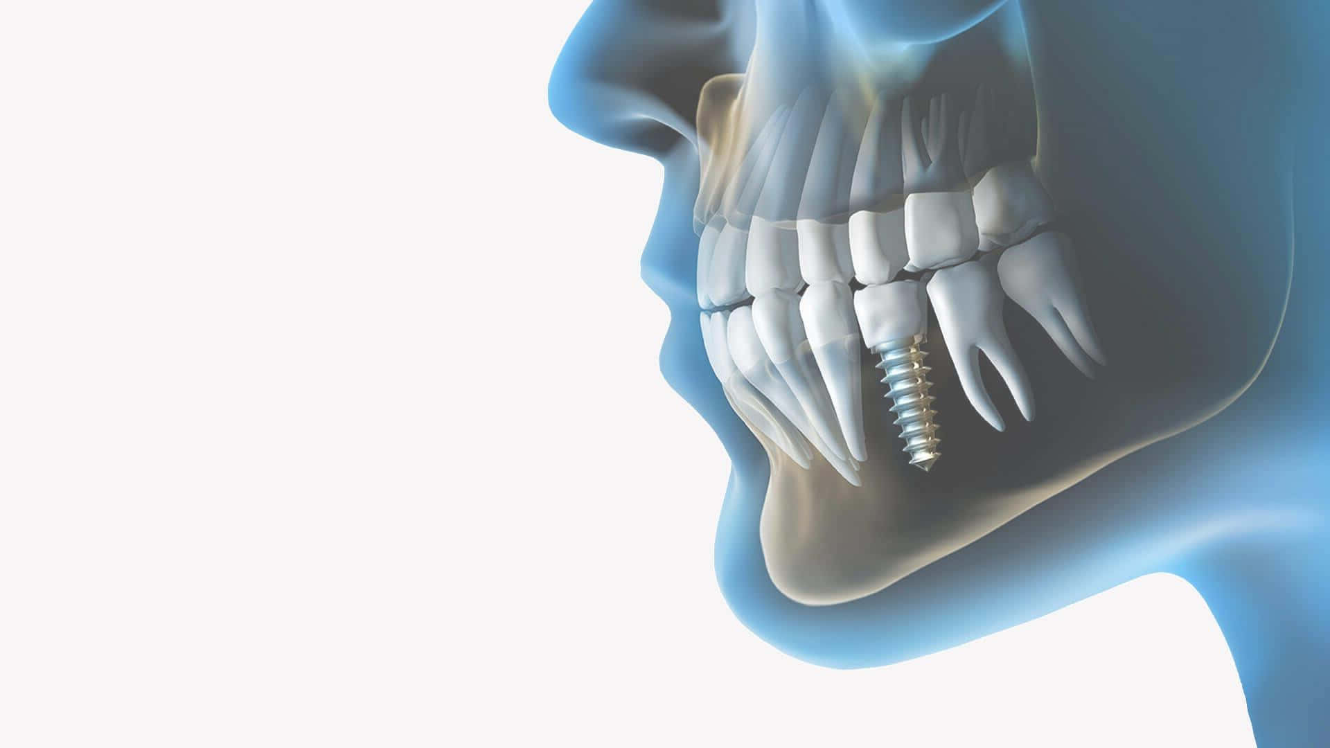 A Person's Mouth With Dental Implants In It