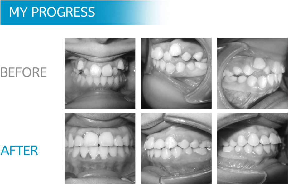 Dental Progress Before After PNG