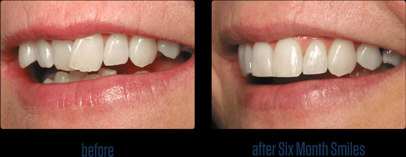 Dental_ Transformation_ Before_ After PNG