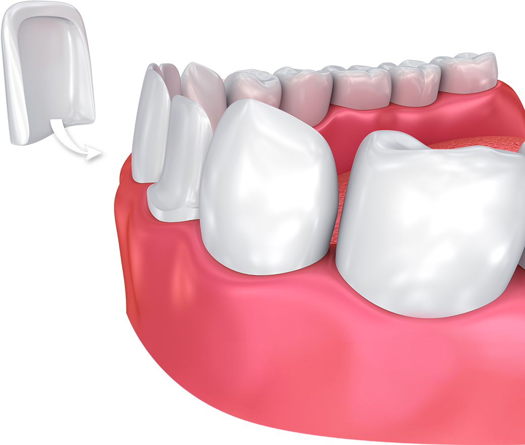 Dental Veneer Placement3 D Illustration PNG