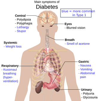 Diabetic Ketoacidosis Symptoms Infographic PNG