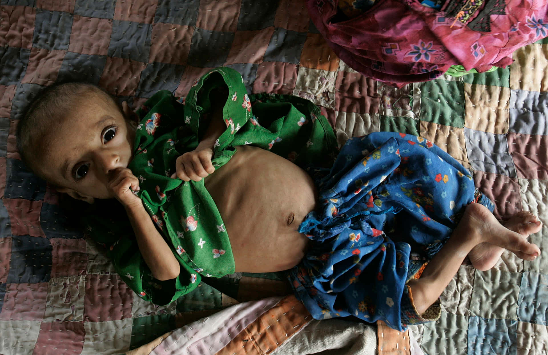 Emaciated Child With A Big Stomach Wallpaper