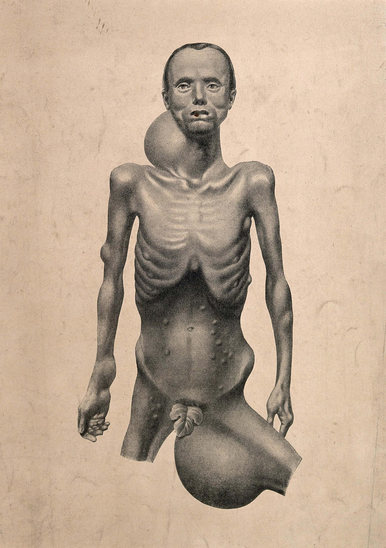 Emaciated Man With Swellings Wallpaper