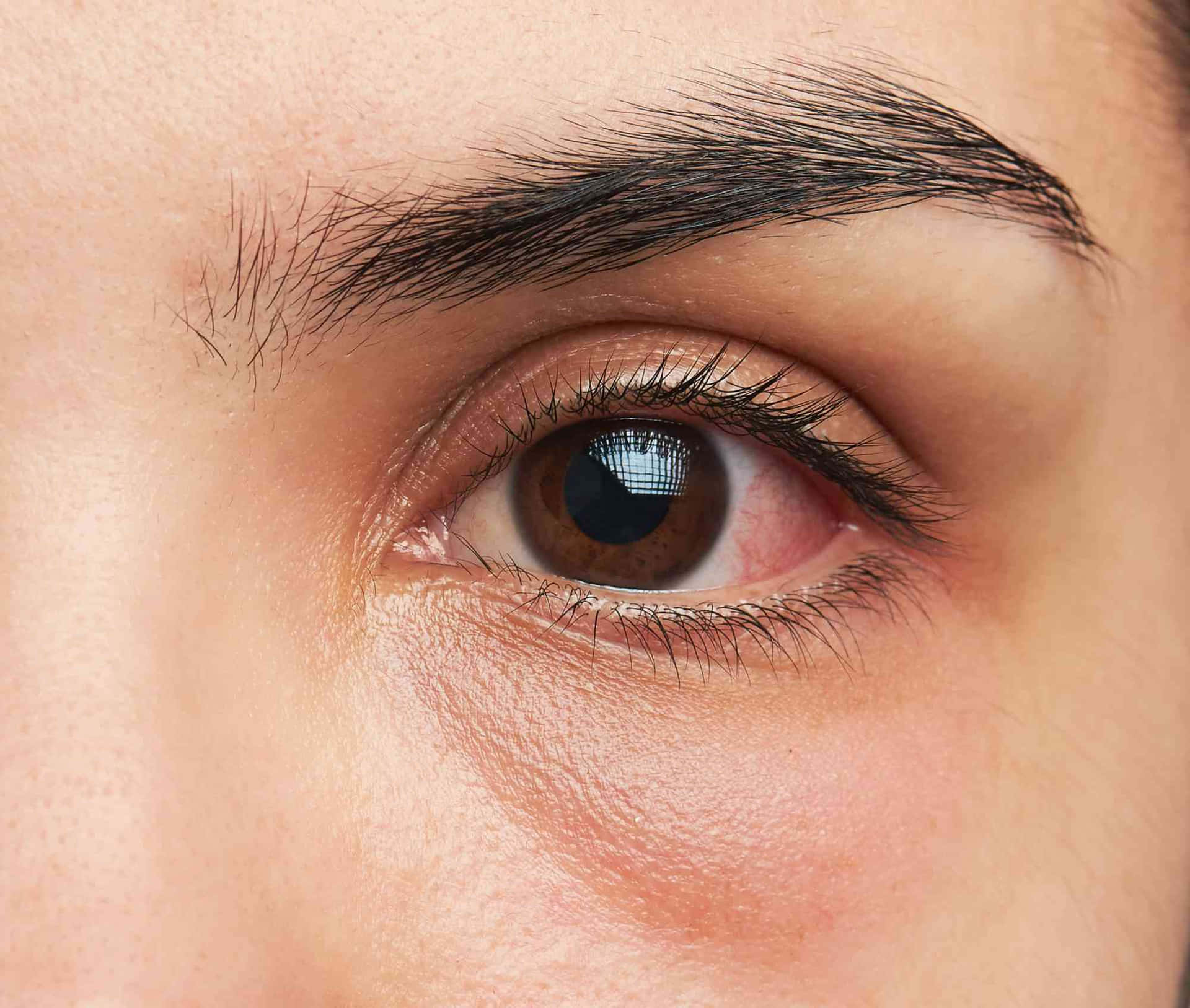 A Woman's Eye With Redness And Swelling
