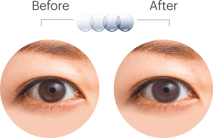 Eye Treatment Before After PNG