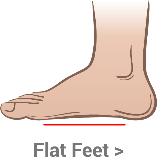 Flat Foot Condition Illustration PNG