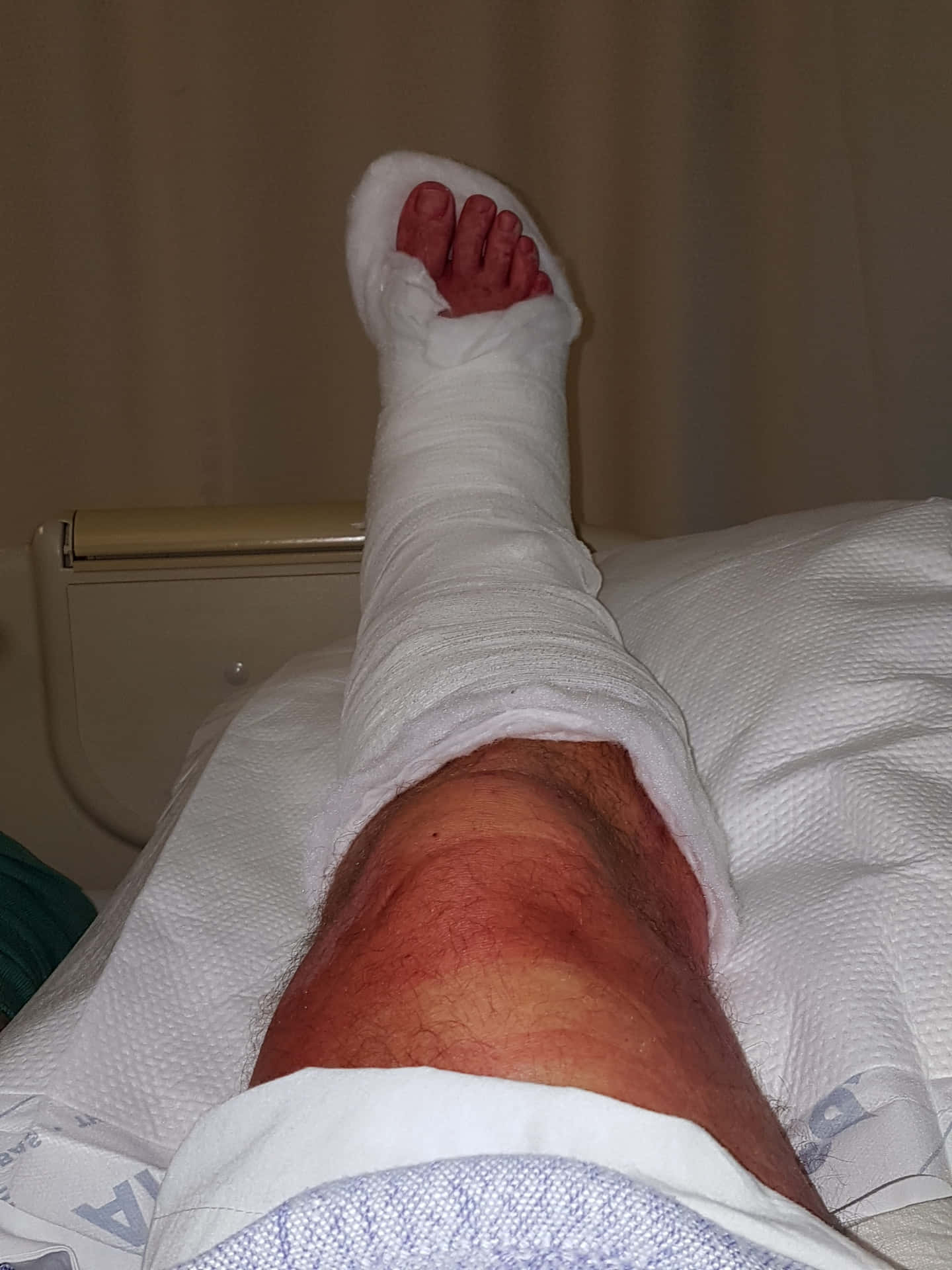 Verletzterfuß Mit Bandage Bild