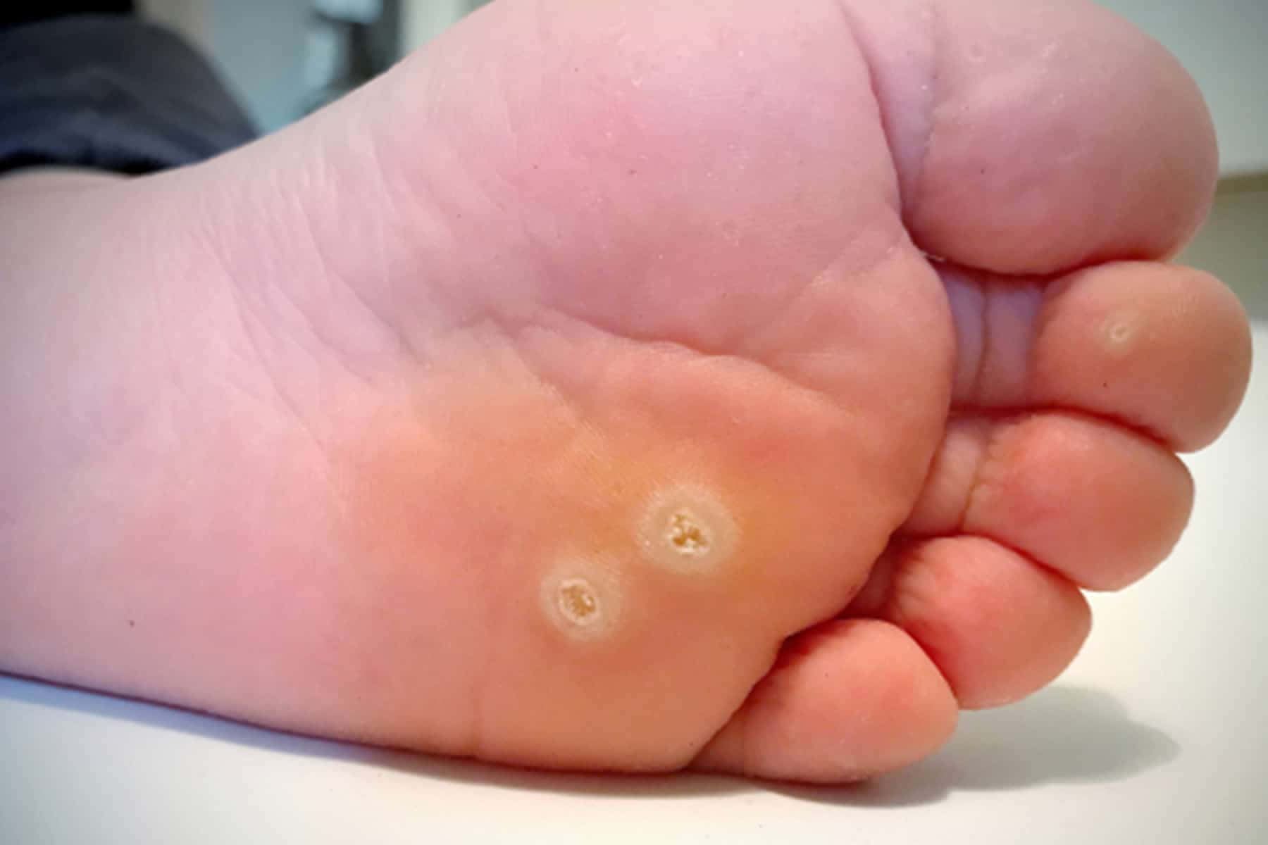 Et barns fod med en lille hvid plet på det.