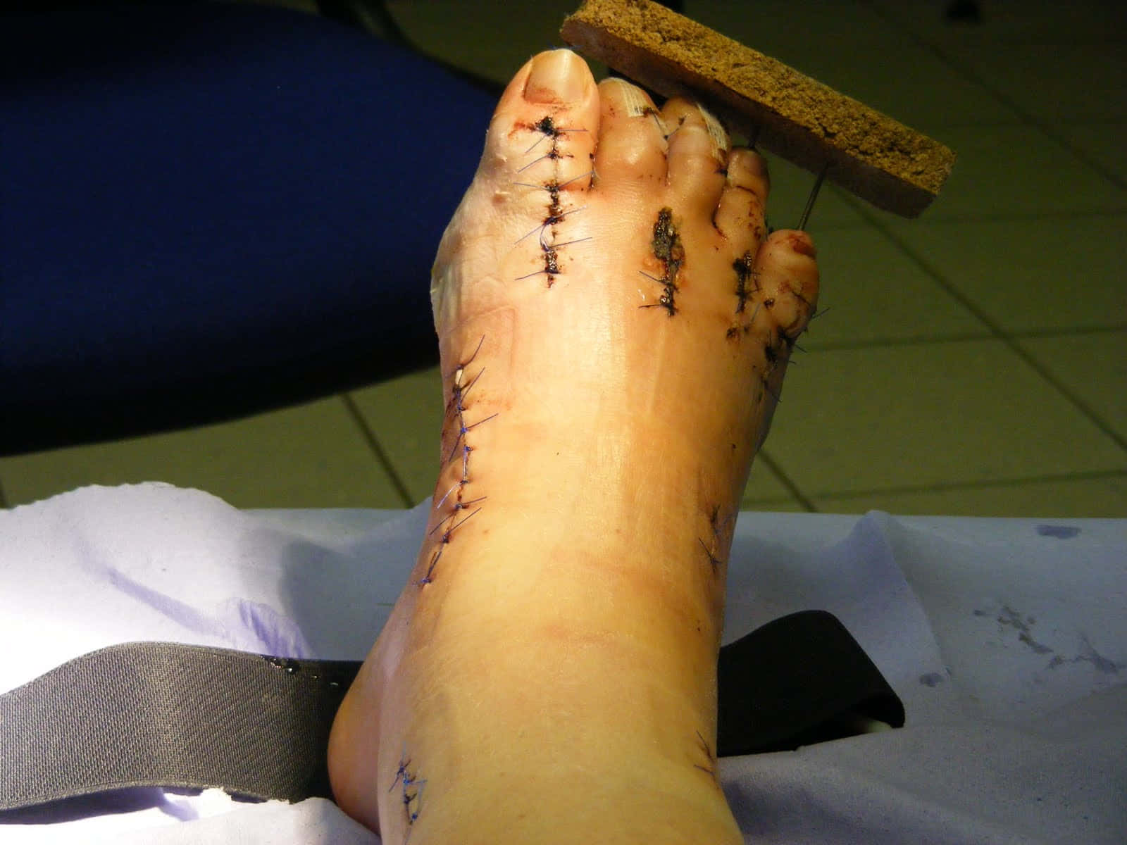Injured Foot After Surgery Picture