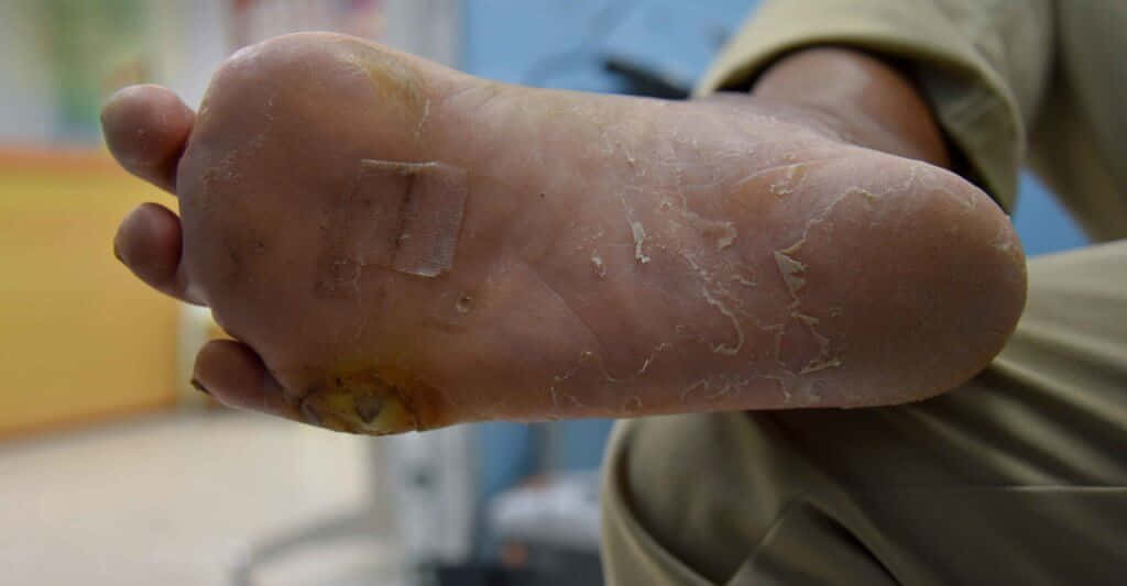 Bildeines Trockenen Haut Fußsohle.