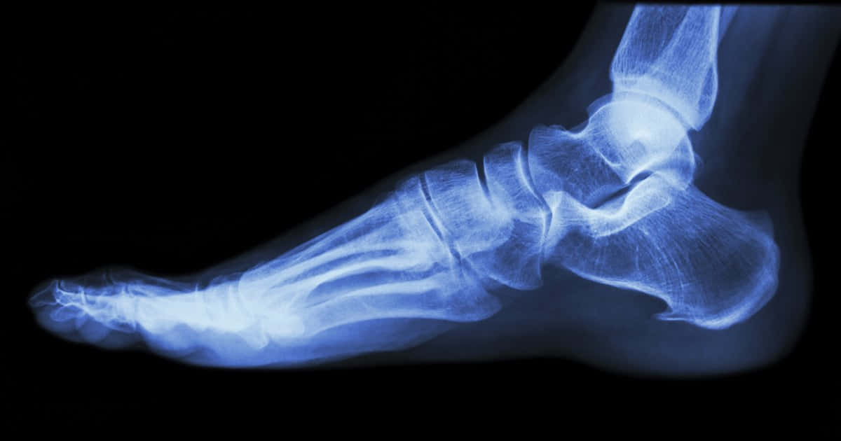 Fotbenensröntgenbild.
