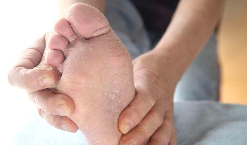 Bildvon Einem Fuß Mit Trockener Haut