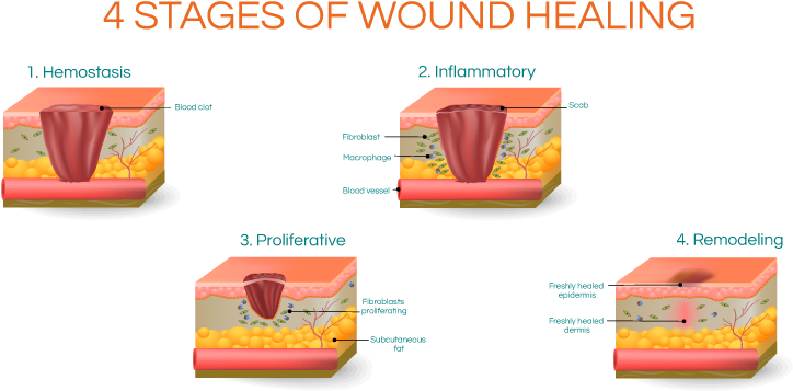 Download Four Stagesof Wound Healing Graphic | Wallpapers.com