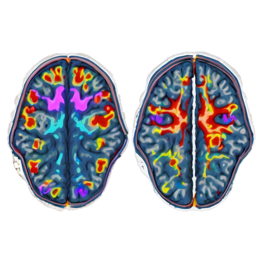 Functional Mri Brain Mapping Png Nhs PNG