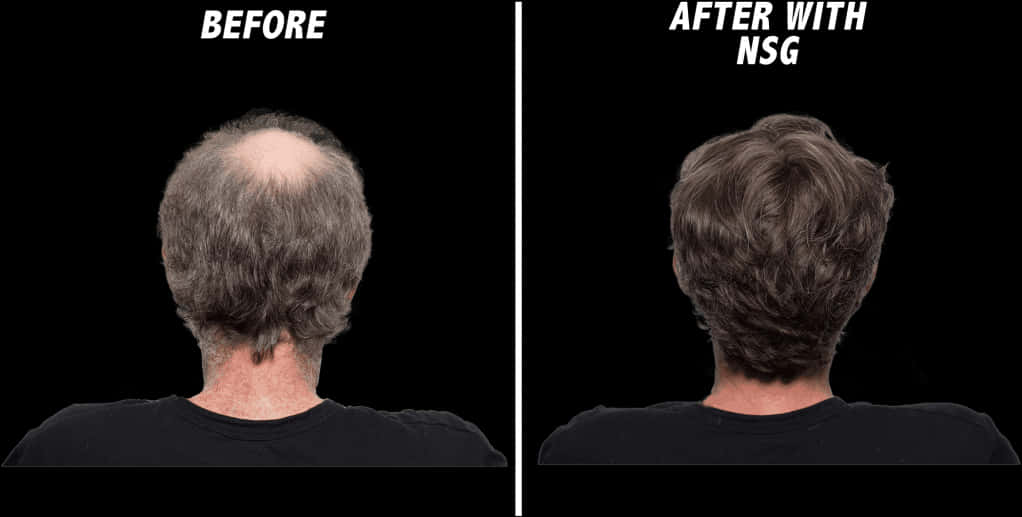 Hair Restoration Before After N S G PNG