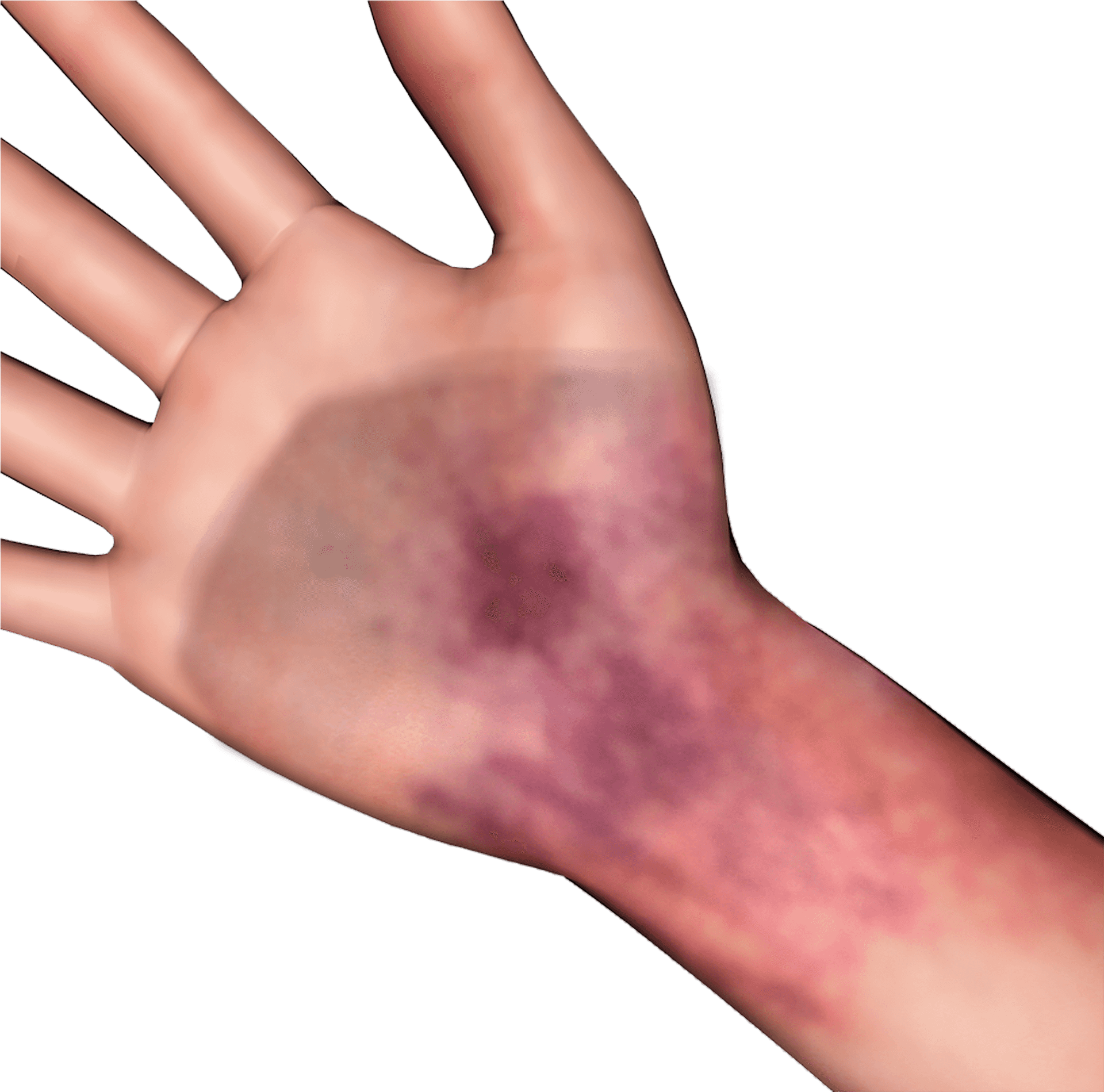 Download Handwith Bruise Image 