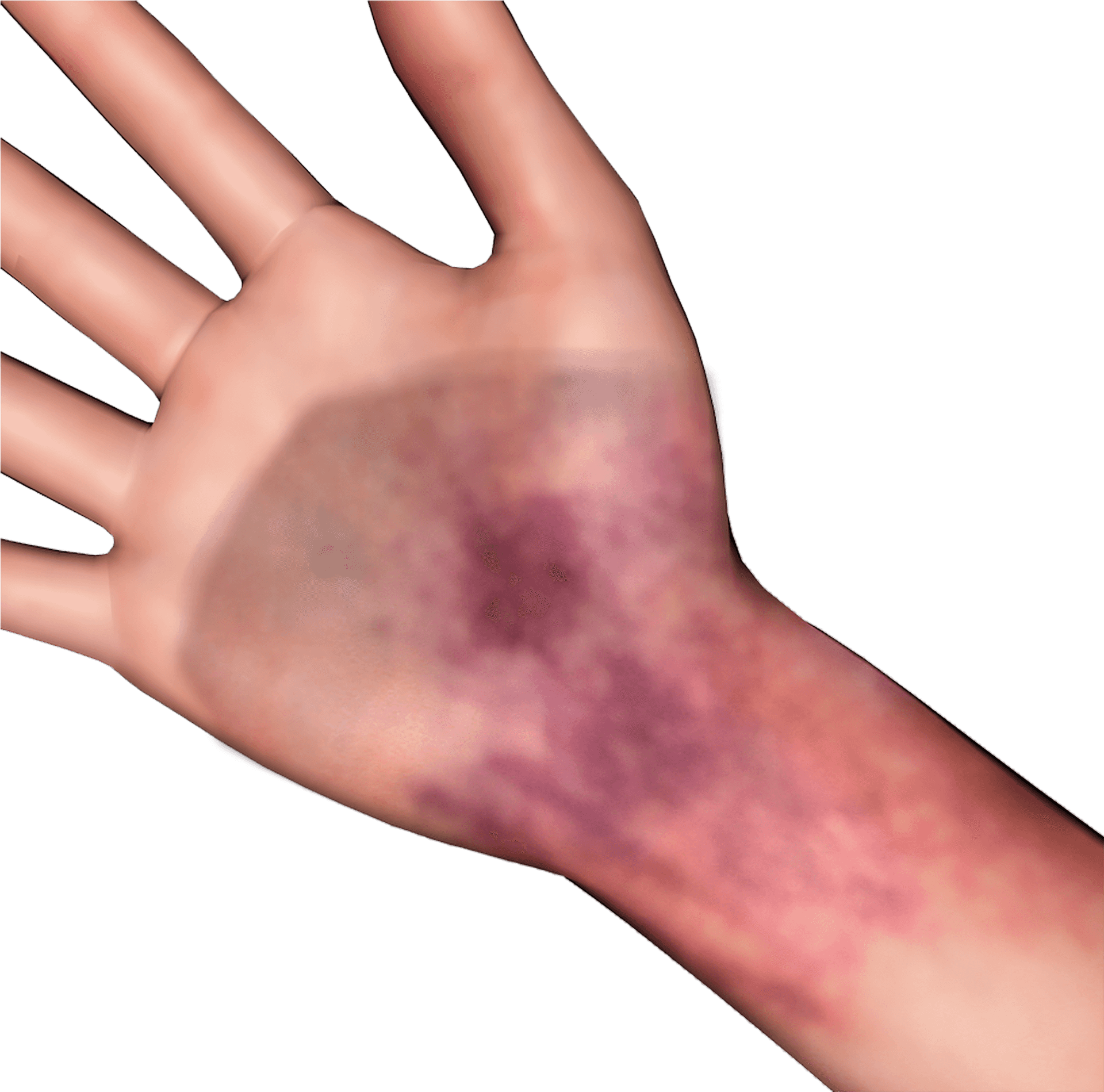 Handwith Bruise Image PNG