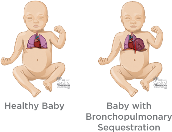 Healthy_vs_ Bronchopulmonary_ Sequstration_ Babies PNG
