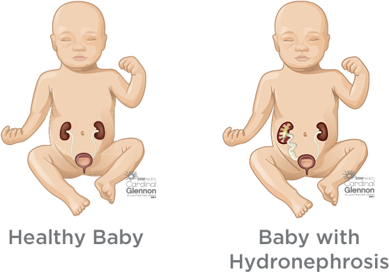 Healthyvs Hydronephrosis Baby Kidney Comparison PNG