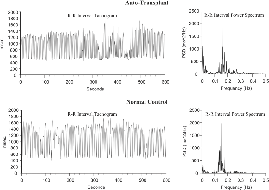 Heart Rate Variability Comparison Auto Transplantvs Normal Control PNG