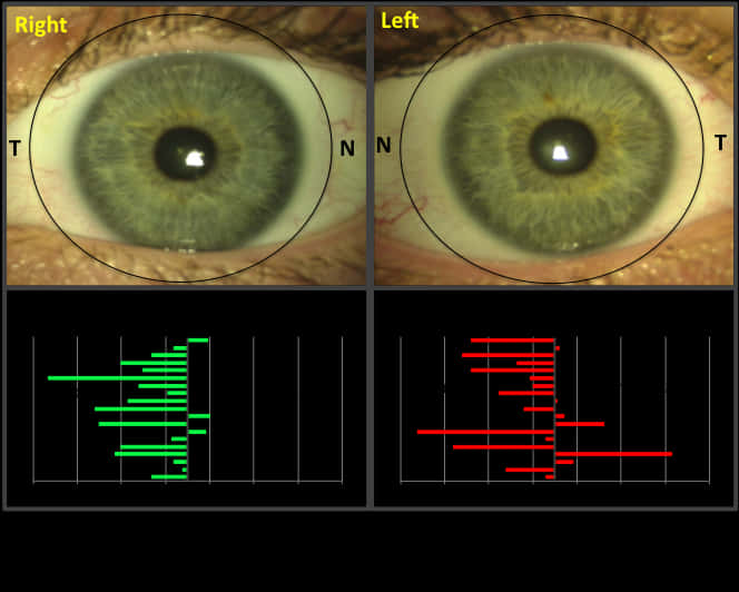 Human Eye Comparison Corneal Topography PNG