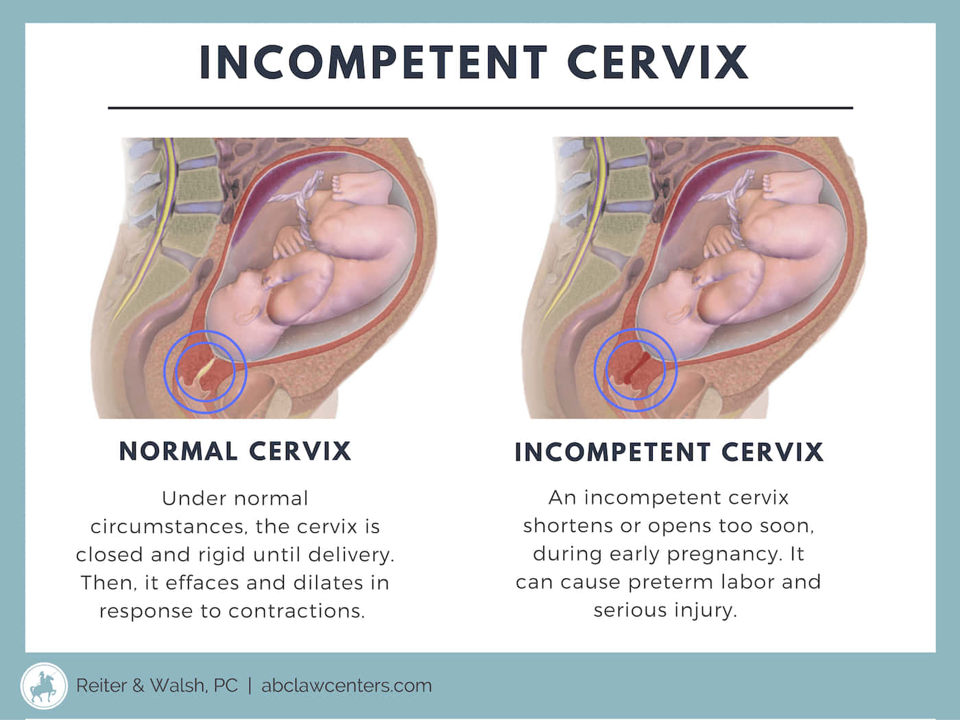 Incompetent Cervix Wallpaper