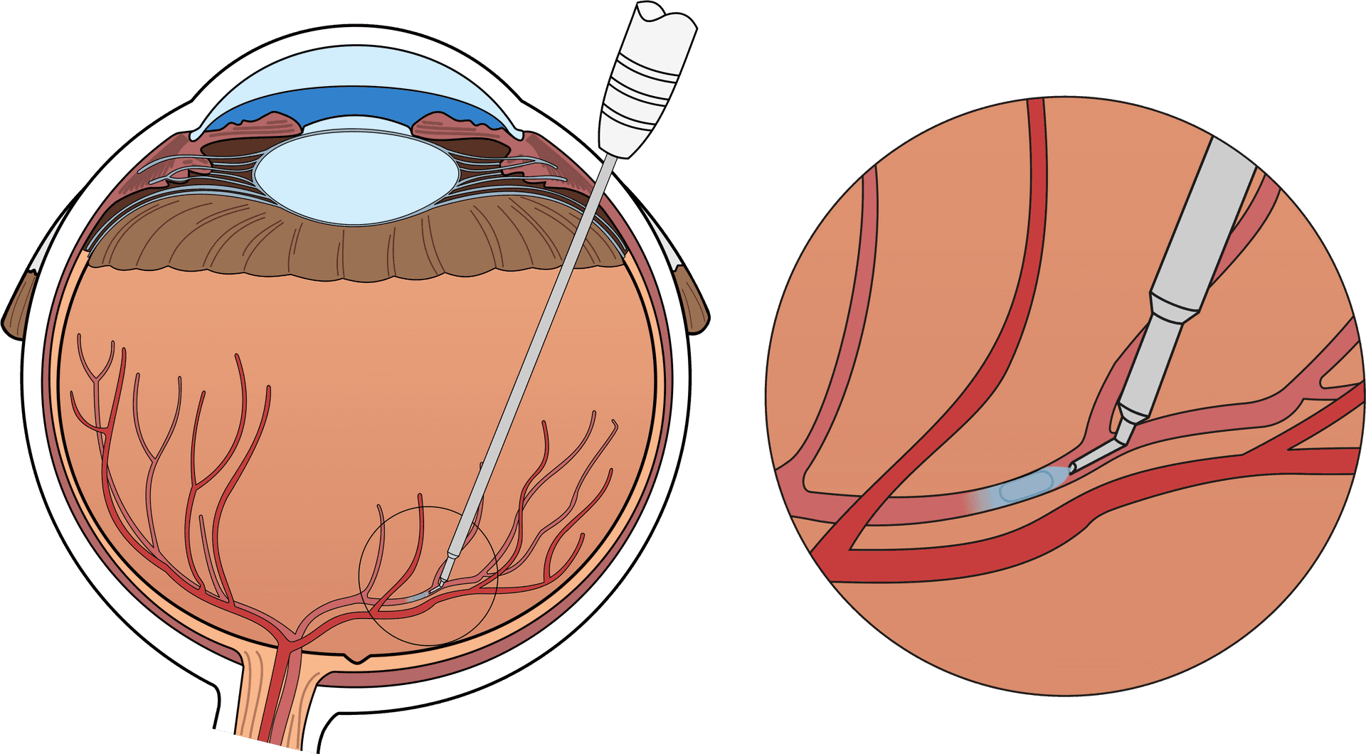 Intravitreal Injection Eye Treatment PNG