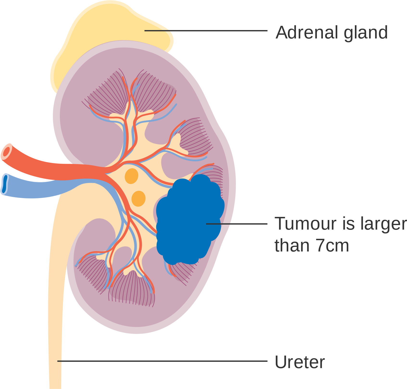 Kidney Anatomywith Tumor Illustration PNG