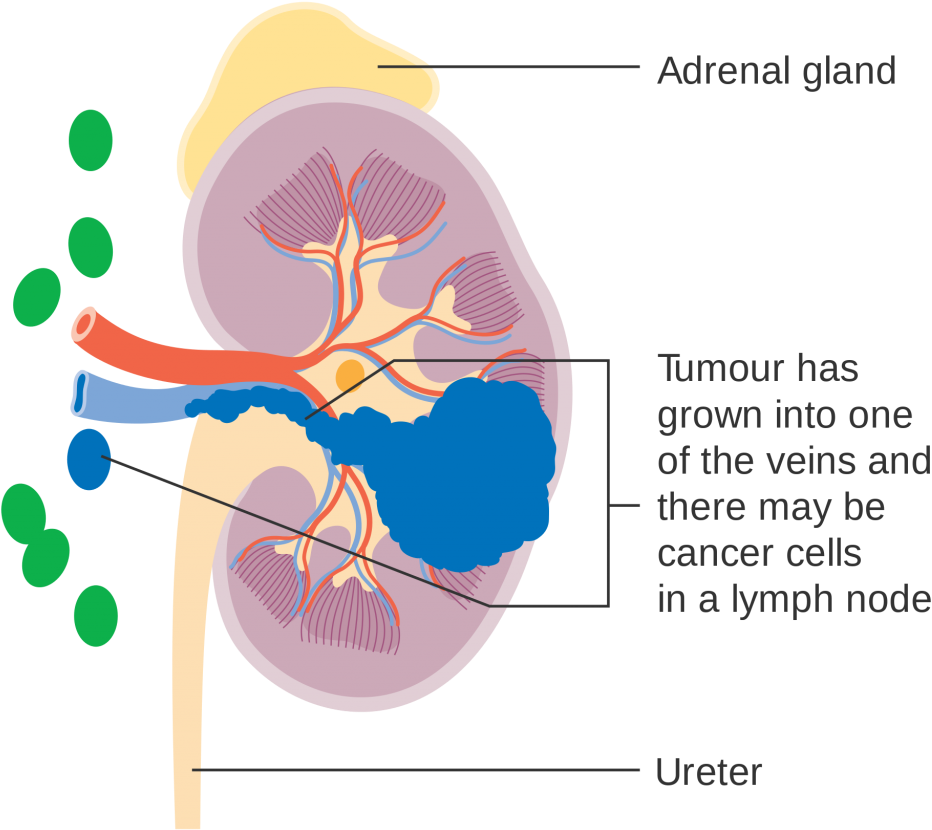 Kidney Cancer Diagram PNG