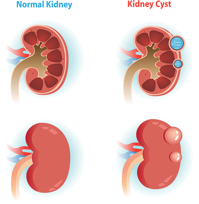 Kidney Health Comparison Illustration PNG
