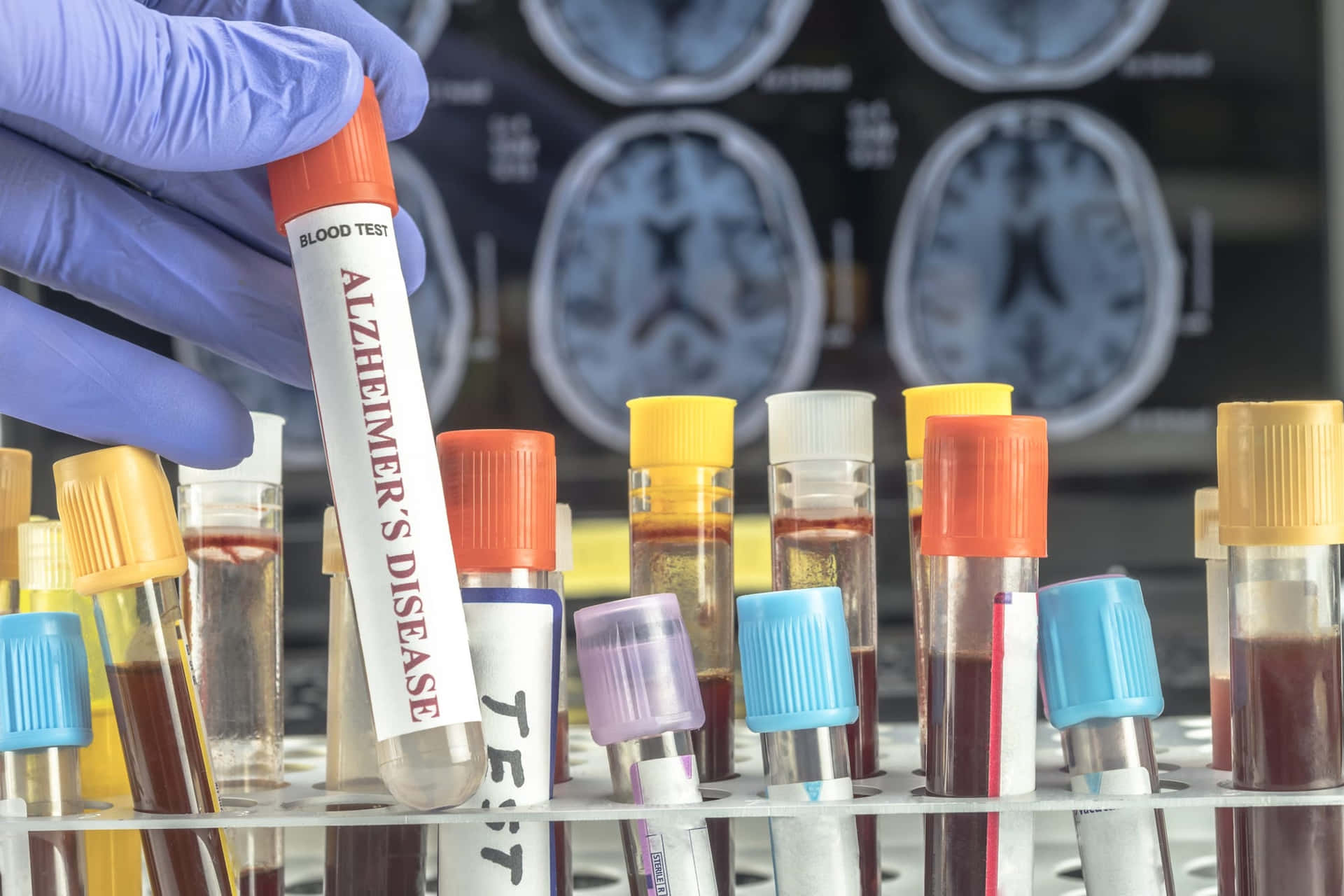 Laboratory Blood Sample Alzheimer's Wallpaper