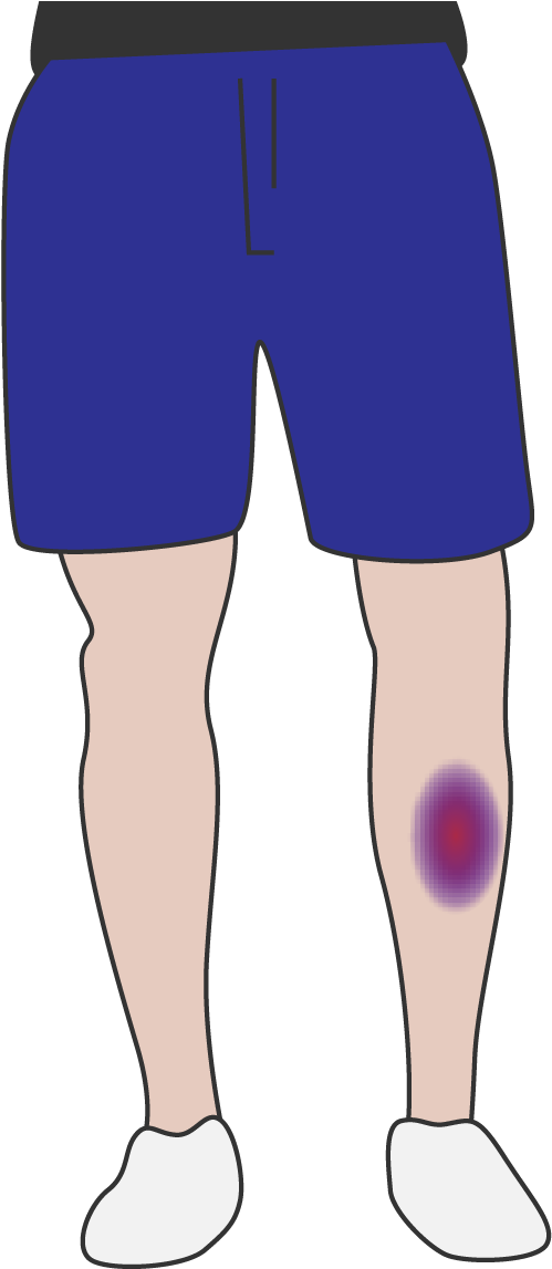 Leg Bruise Illustration PNG