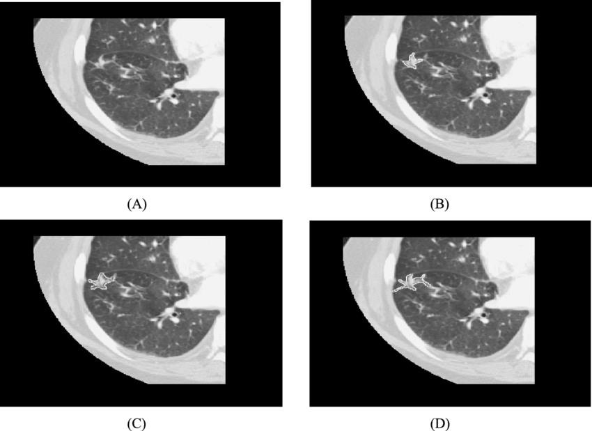Lung C T Scan Quadrants PNG