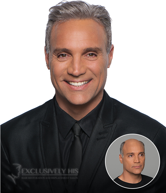 Mature Man Hair Restoration Transformation PNG