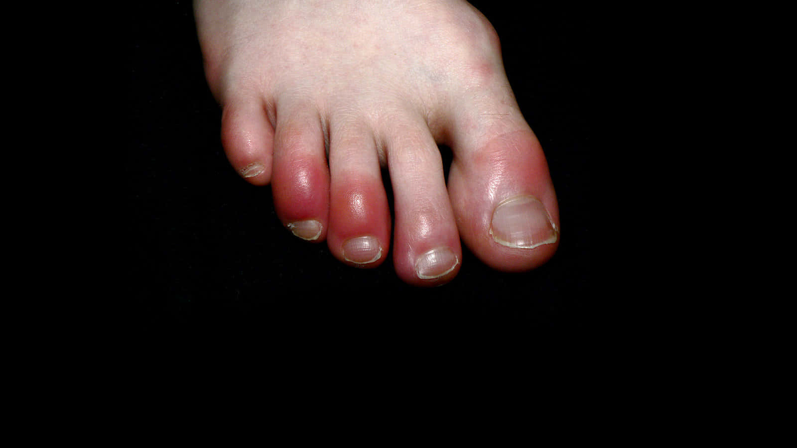 A Close-up View of Covid Toes Syndrome Wallpaper
