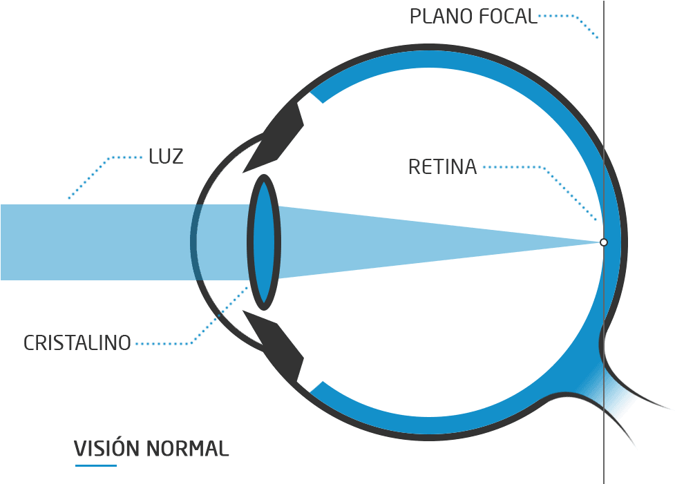 Normal Vision Light Refraction Diagram PNG