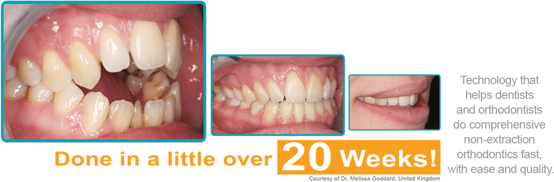 Orthodontic Treatment Progress20 Weeks PNG