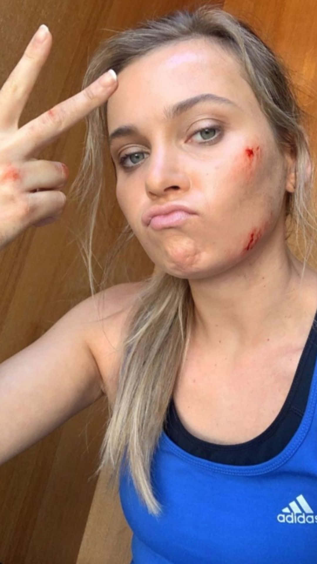 Peace Sign Selfie With Fake Injuries Wallpaper