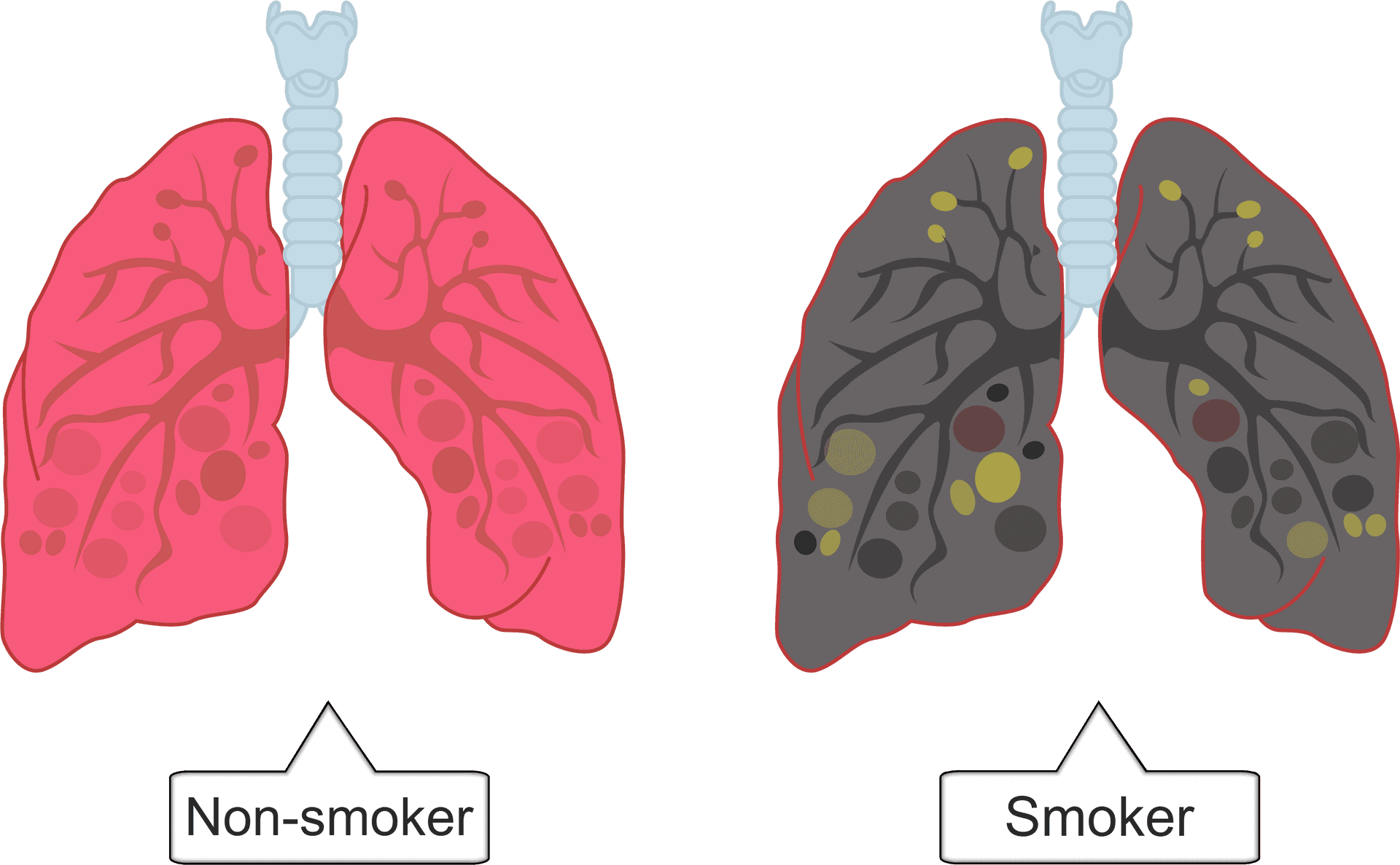 Smokervs Non Smoker Lung Comparison PNG